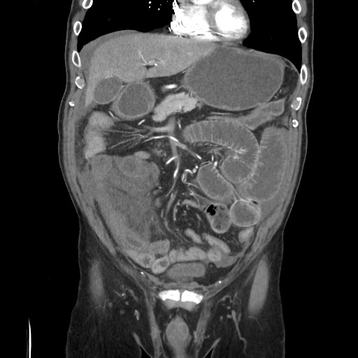 File:Closed loop obstruction due to adhesive band, resulting in small bowel ischemia and resection (Radiopaedia 83835-99023 C 45).jpg