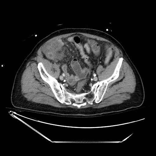 File:Closed loop obstruction due to adhesive band, resulting in small bowel ischemia and resection (Radiopaedia 83835-99023 D 122).jpg
