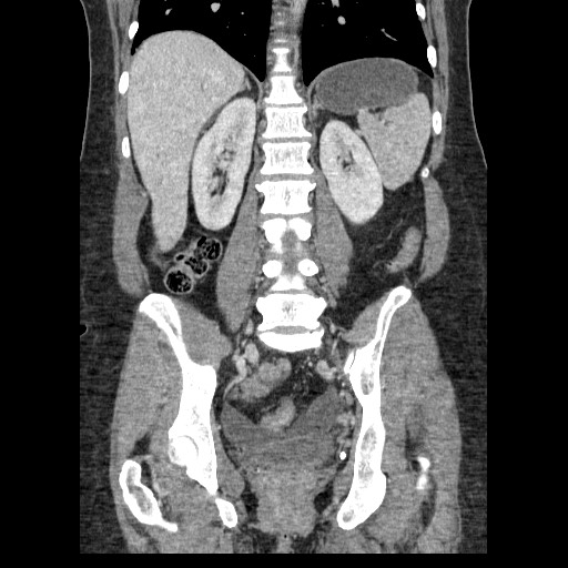File:Closed loop small bowel obstruction (Radiopaedia 65403-74451 B 71).jpg