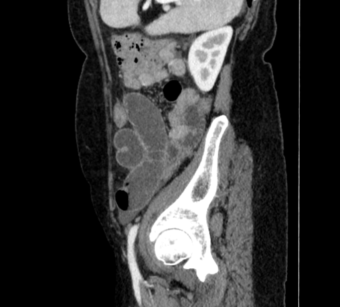 Closed loop small bowel obstruction (Radiopaedia 71211-81508 C 133).jpg