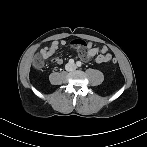 Closed loop small bowel obstruction - internal hernia (Radiopaedia 57806-64778 B 76).jpg