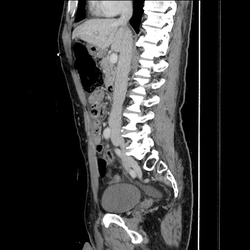 Closed loop small bowel obstruction - omental adhesion causing "internal hernia" (Radiopaedia 85129-100682 C 84).jpg