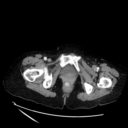 File:Closed loop small bowel obstruction due to adhesive band, with intramural hemorrhage and ischemia (Radiopaedia 83831-99017 Axial 144).jpg