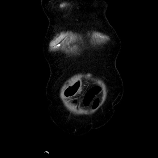 Closed loop small bowel obstruction due to adhesive band, with intramural hemorrhage and ischemia (Radiopaedia 83831-99017 C 17).jpg