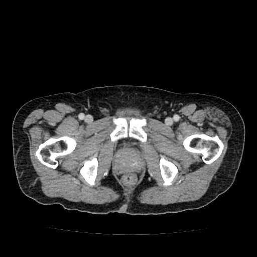 File:Closed loop small bowel obstruction due to adhesive band - U-shaped loop (Radiopaedia 83829-99012 A 72).jpg