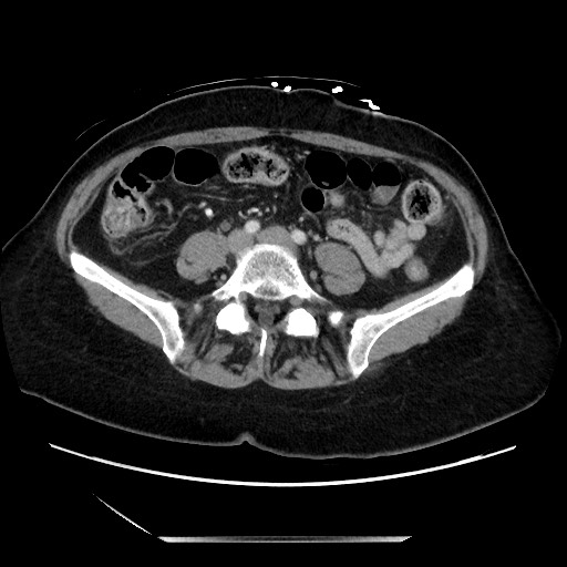 File:Closed loop small bowel obstruction due to adhesive bands - early and late images (Radiopaedia 83830-99014 Axial 10).jpg