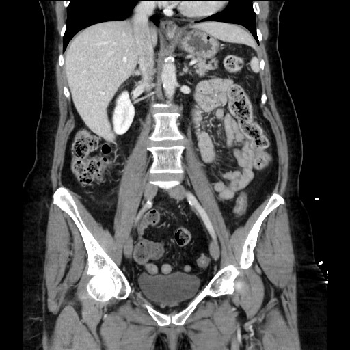 Closed loop small bowel obstruction due to adhesive bands - early and late images (Radiopaedia 83830-99014 B 66).jpg