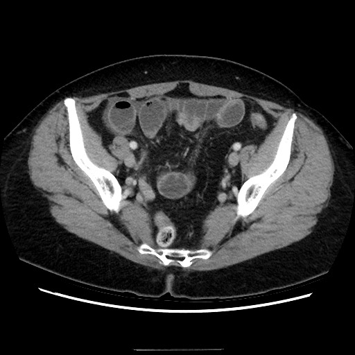 Closed loop small bowel obstruction due to adhesive bands - early and late images (Radiopaedia 83830-99015 A 135).jpg