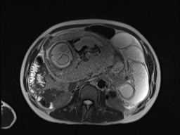 File:Closed loop small bowel obstruction in pregnancy (MRI) (Radiopaedia 87637-104031 Axial T2 35).jpg