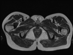 Closed loop small bowel obstruction in pregnancy (MRI) (Radiopaedia 87637-104031 D 45).jpg