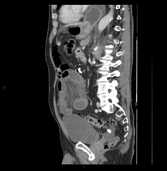 File:Closed loop small bowel obstruction with ischemia (Radiopaedia 84180-99456 C 54).jpg