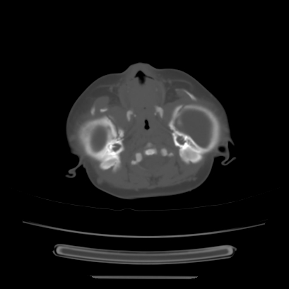Cloverleaf skull (Radiopaedia 91901-109710 Axial bone window 40).jpg