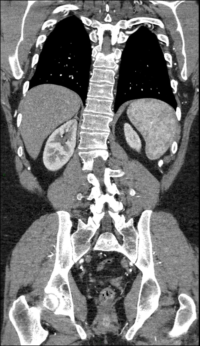 Coarctation of the aorta (Radiopaedia 74632-88521 B 186).jpg