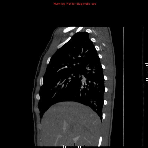 File:Coarctation of the aorta (Radiopaedia 9434-10118 B 8).jpg
