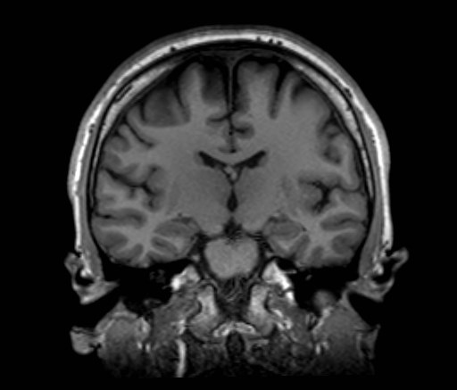 File:Cochlear incomplete partition type III associated with hypothalamic hamartoma (Radiopaedia 88756-105498 Coronal T1 33).jpg