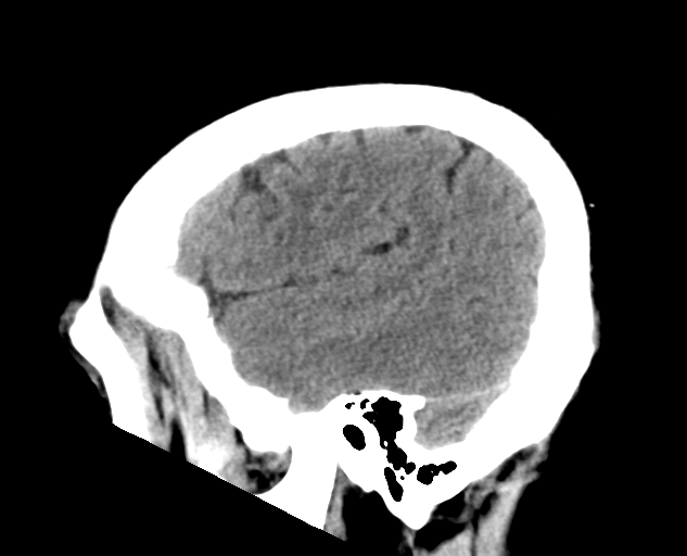 File:Colloid cyst of the third ventricle (Radiopaedia 86571-102661 B 27).png