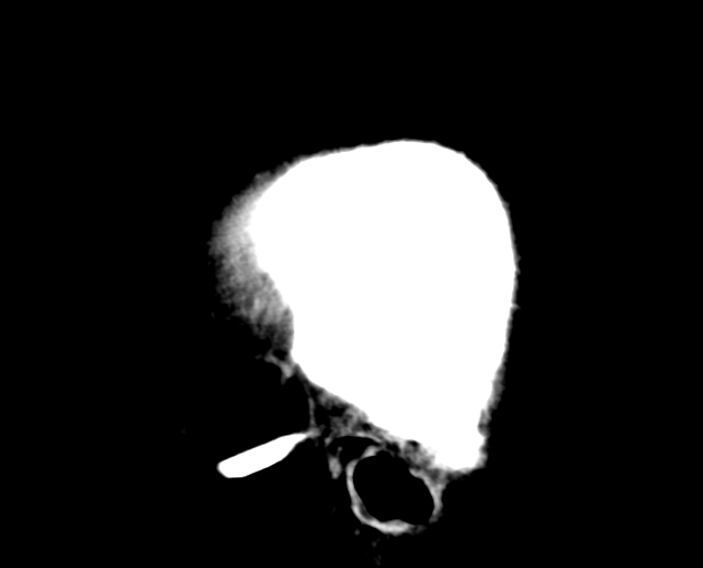 File:Colloid cyst of the third ventricle (Radiopaedia 86571-102661 B 4).png