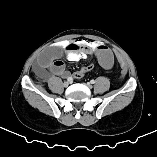 Colocolic intussusception due to large lipoma (Radiopaedia 68773-78482 A 133).jpg