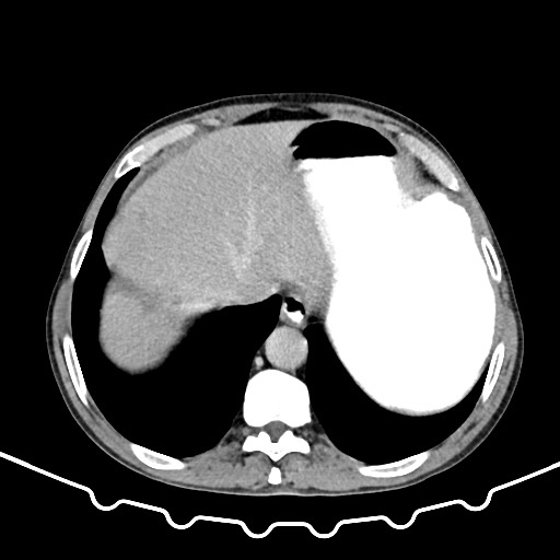 Colocolic intussusception due to large lipoma (Radiopaedia 68773-78482 A 15).jpg
