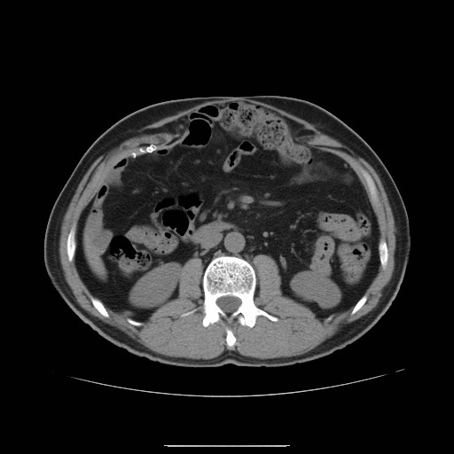 File:Colocutaneous fistula in Crohn's disease (Radiopaedia 29586-30093 D 3).jpg