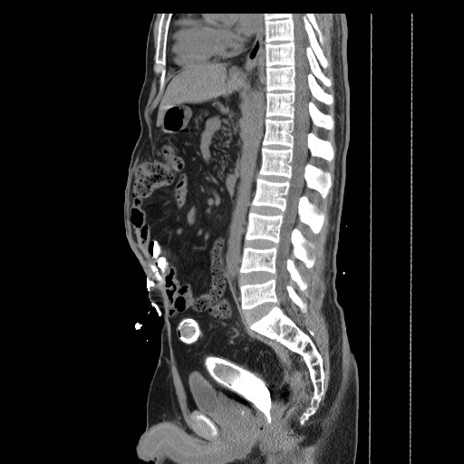 File:Colocutaneous fistula in Crohn's disease (Radiopaedia 29586-30093 F 16).jpg