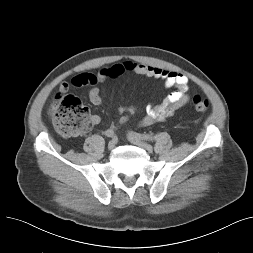 File:Colon adenocarcinoma - splenic flexure (Radiopaedia 34143-35406 Axial Oral contrast 65).png