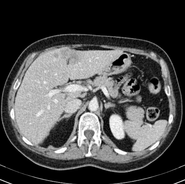 Colon carcinoma with hepatic metastases (Radiopaedia 29477-29961 A 32).jpg