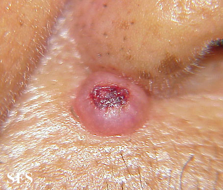 File:Keratoacanthoma (Dermatology Atlas 15).jpg