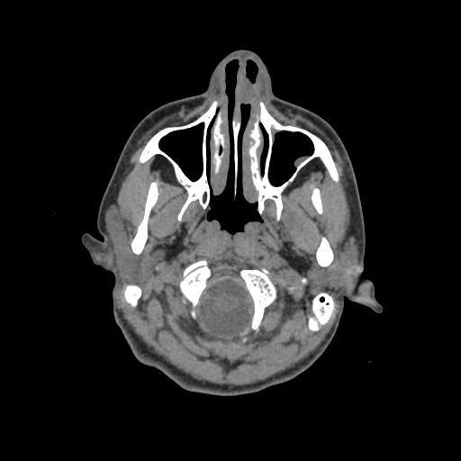 Nasal pyogenic granuloma (lobular capillary hemangioma) (Radiopaedia 85536-101244 Axial non-contrast 27).jpg