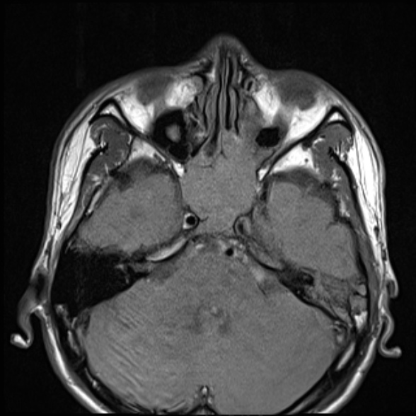 Nasopharyngeal carcinoma with skull base invasion (Radiopaedia 53415-59485 Axial T1 20).jpg