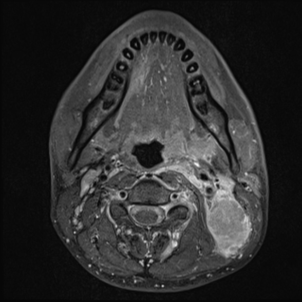 Nasopharyngeal carcinoma with skull base invasion (Radiopaedia 53415-59485 Axial T1 C+ fat sat 43).jpg