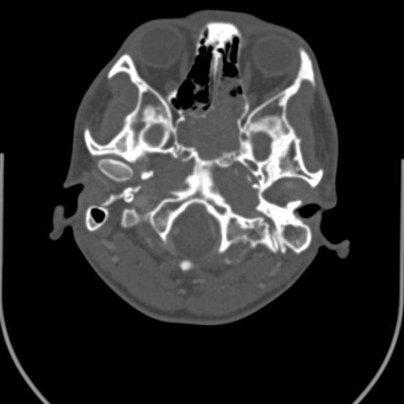 Nasopharyngeal carcinoma with skull base invasion (Radiopaedia 53415-59705 Axial bone window 26).jpg