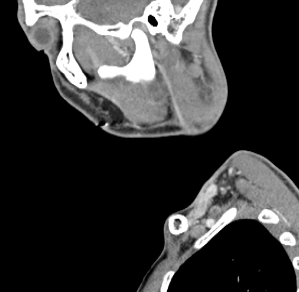 File:Nasopharyngeal carcinoma with skull base invasion (Radiopaedia 53415-59705 C 62).jpg
