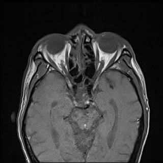 Nasopharyngeal carcinoma with skull base invasion (Radiopaedia 59258-66600 B 7).jpg
