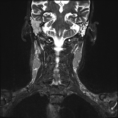 Nasopharyngeal carcinoma with skull base invasion (Radiopaedia 59258-66600 Coronal T2 fat sat 7).jpg