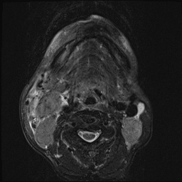 File:Nasopharyngeal carcinoma with skull base invasion (Radiopaedia 59258-66600 D 43).jpg