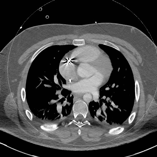 Neck CT angiogram (intraosseous vascular access) (Radiopaedia 55481-61945 B 1).jpg