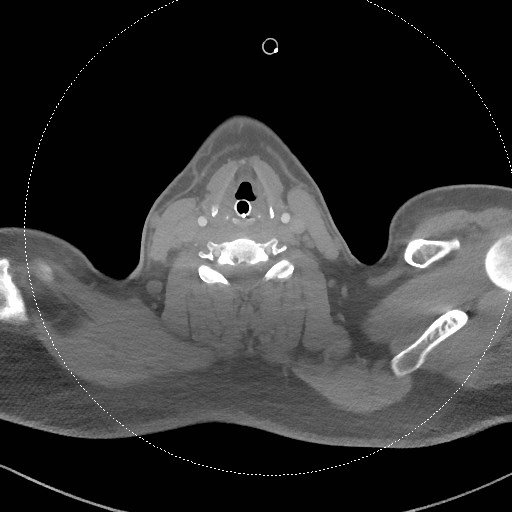 Neck CT angiogram (intraosseous vascular access) (Radiopaedia 55481-61945 B 161).jpg