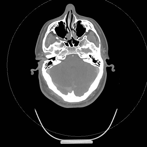 Neck CT angiogram (intraosseous vascular access) (Radiopaedia 55481-61945 B 274).jpg
