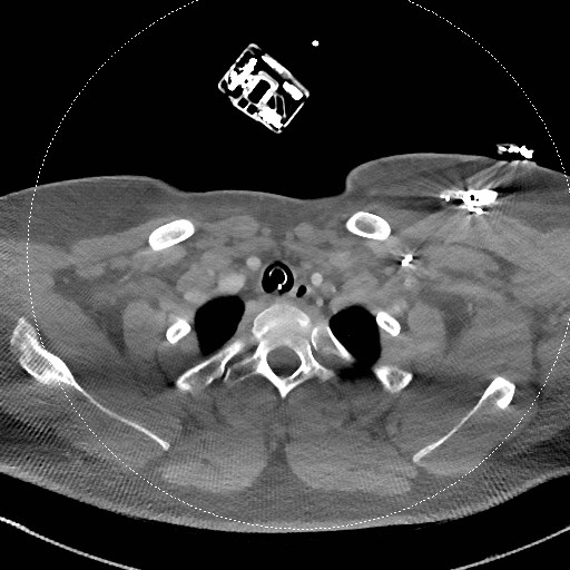 Neck CT angiogram (intraosseous vascular access) (Radiopaedia 55481-61945 B 99).jpg