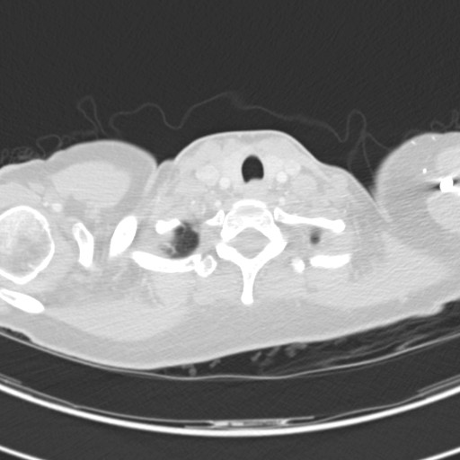 Necrobiotic pulmonary nodules - Crohn disease (Radiopaedia 20723-20631 Axial lung window 8).jpg
