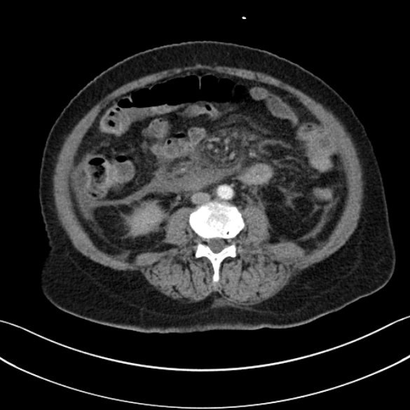 File:Necrotizing emphysematous pancreatitis (Radiopaedia 25727-25893 A 80).jpg