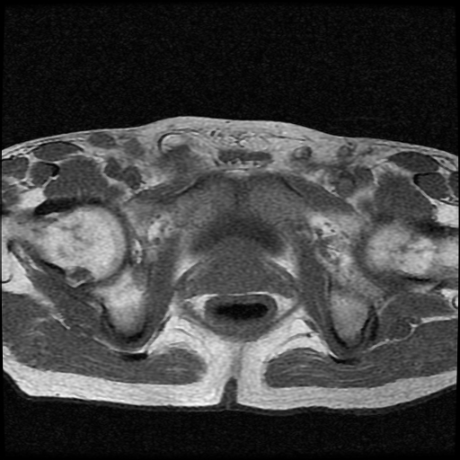 File:Necrotizing epididymo-orchitis with intra-testicular abscess (Radiopaedia 29397-29860 Axial T1 4).jpg