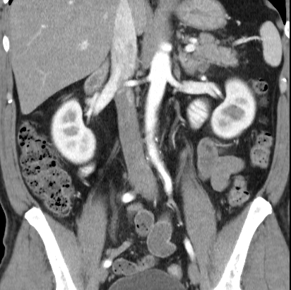 File:Necrotizing pancreatitis with acute necrotic collection (Radiopaedia 14470-14417 C 23).jpg
