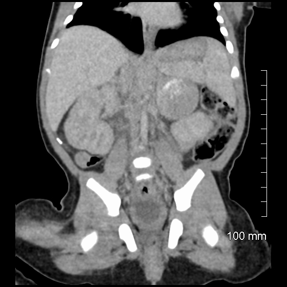 File:Neonatal neuroblastoma (Radiopaedia 56651-63438 Coronal non-contrast 31).jpg