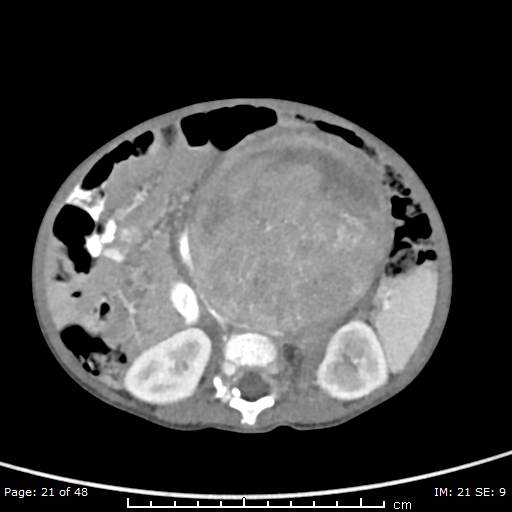 File:Neuroblastoma (Radiopaedia 41472-44355 A 21).jpg