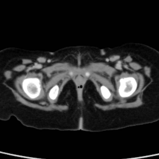 Neuroblastoma with skull metastases (Radiopaedia 30326-30960 C 64).jpg