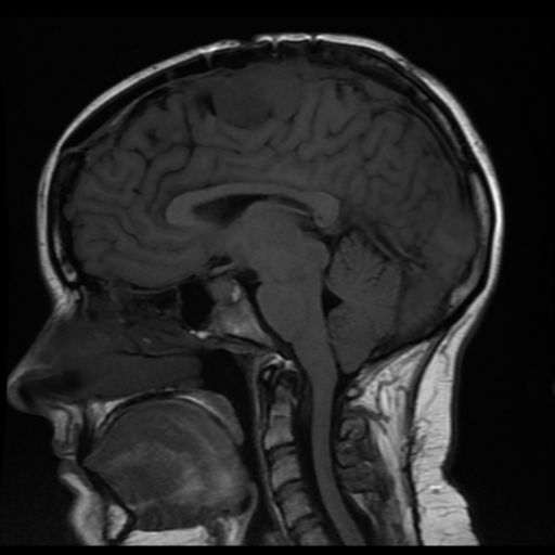 File:Neurofibromatosis type 2 (Radiopaedia 45229-49251 Sagittal T1 11).png