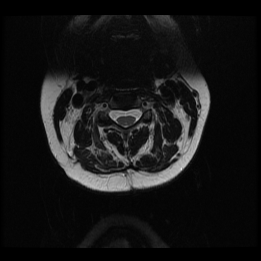 File:Neurofibromatosis type 2 (Radiopaedia 45229-49252 Axial T2 17).png
