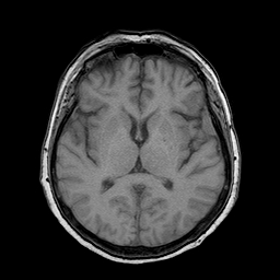 File:Neurofibromatosis type 2 (Radiopaedia 8713-9518 Axial T1 12).jpg